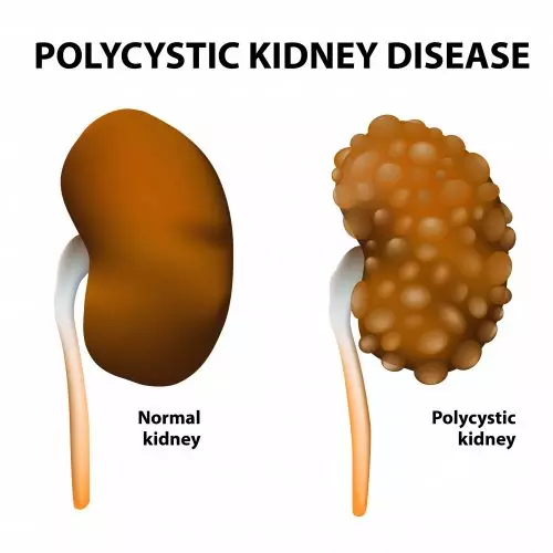 Polycystic Kidney Disease: Symptoms, Diagnosis, and Treatment—Responsum Health Illustration of comparison of normal kidney vs kidney with polycystic kidney disease